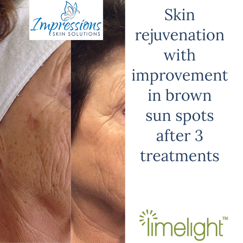 hyperpigmentation skin rejuvenation before and after treatment Hendersonville TN