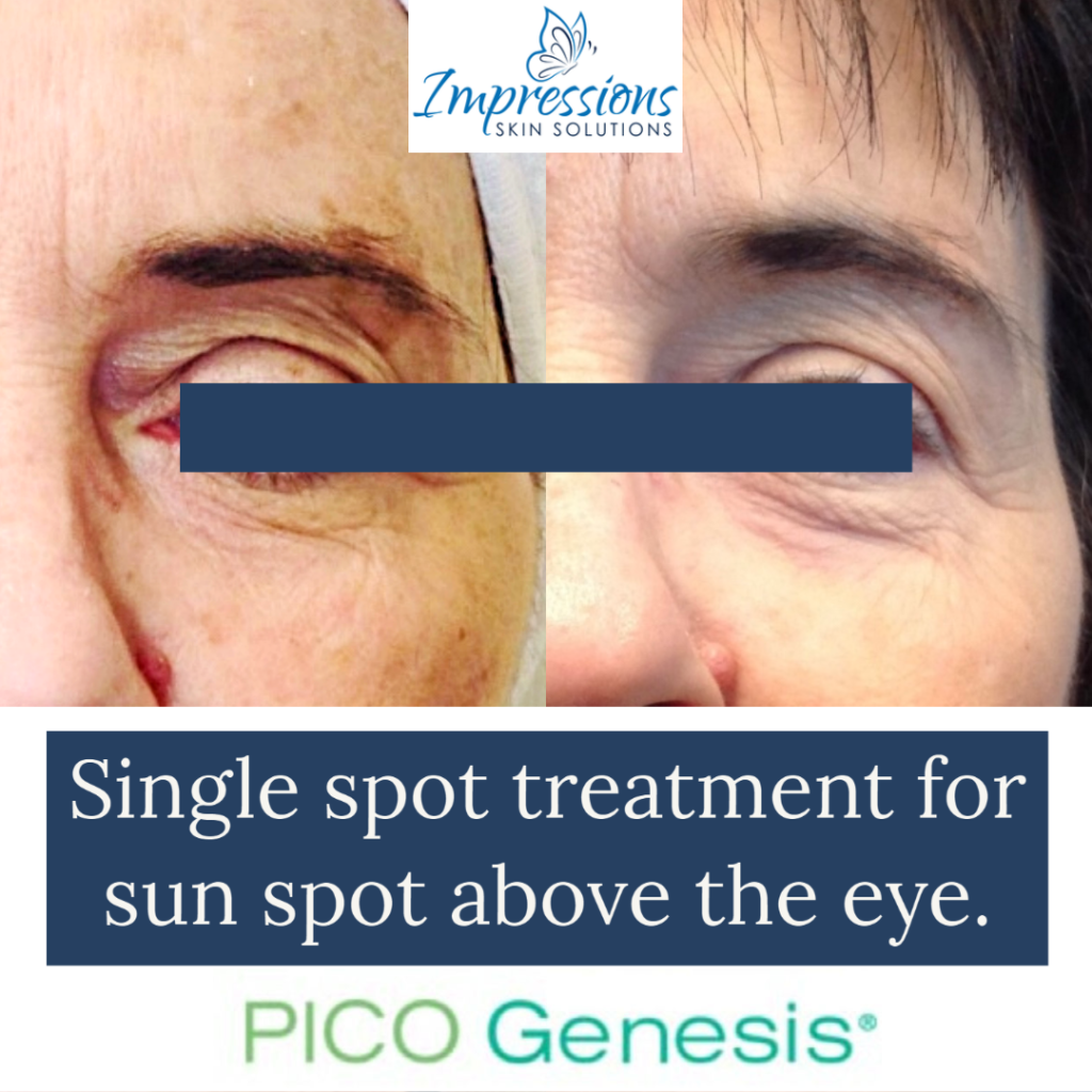 hyperpigmentation spot treatment before and after treatment Hendersonville TN